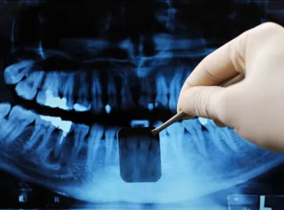 Análisis de radiografías para revisar un 
                        injerto de hueso
